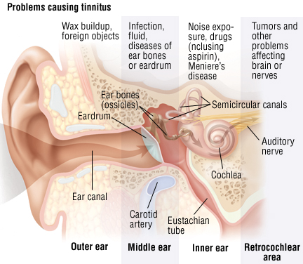 Ear Ringing Tinnitus
